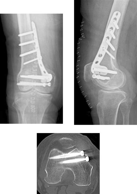 Medial Femoral Condyle Fracture