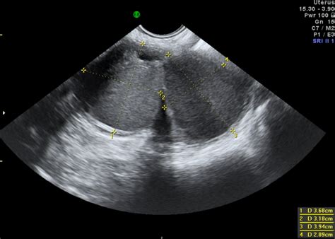 Chapter 3 – Endometriosis – Melaka Fertility
