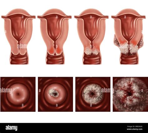 Cervical Cancer Hi Res Stock Photography And Images Alamy