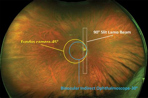 Optos Fundus Camera Cost Informacionpublica Svet Gob Gt