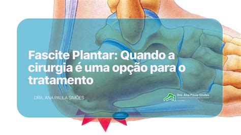 Fascite Plantar Quando A Cirurgia Uma Op O Para O Tratamento