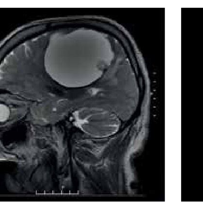 Brain MRI T2 WI axial section Рисунок 2 МРТ головного мозга Т2 ВИ