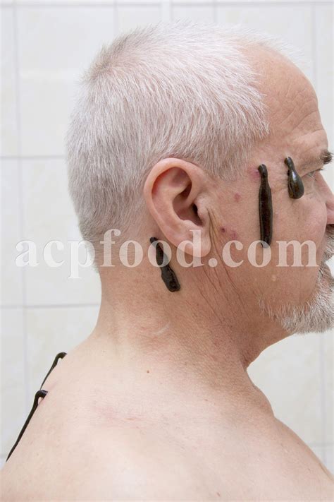 Leech Therapy Treatment Of 111 Diseases Acpfood