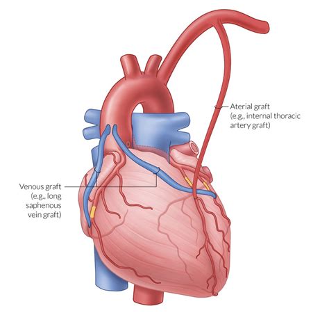 Coronary Artery Bypass Graft Diagram