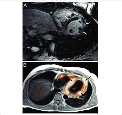 A Years Old Man With History Of Cardiac Sarcoidosis And