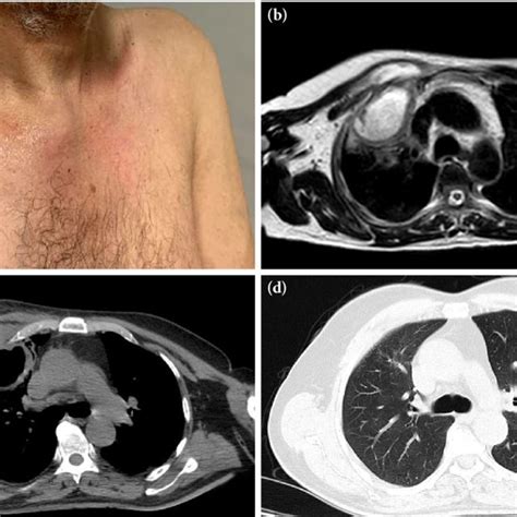 Pdf Em Staphylococcus Aureus Costochondritis And Chest Wall Abscess