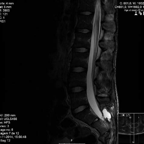 Lumbosacral MRI demonstrating post-traumatic meningocele in sagittal ...