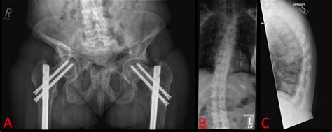 Patient Musculoskeletal Radiology X Ray Ap Pelvis A Shows Evidence Download Scientific