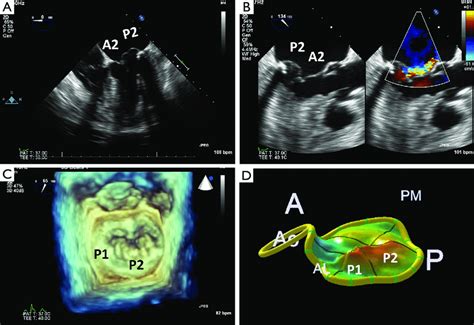 Assessment Of Mitral Valve Disease A Review Of Imaging Modalities My XXX Hot Girl