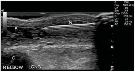 Olecranon Bursa Aspiration and Injection - WikiSM (Sports Medicine Wiki)