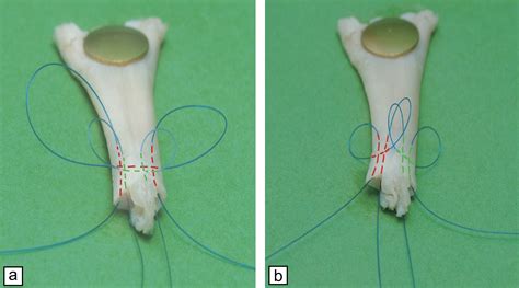 A Technique To Facilitate Symmetrical And Atraumatic Placement Of The