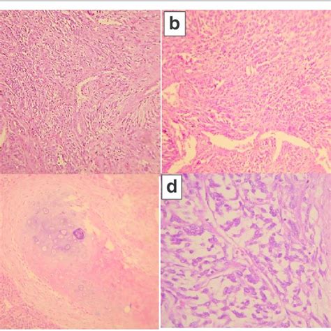 CK AE1 AE3 And TTF 1 Are Positive In Epithelial Component C E