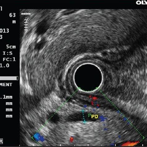 Radial Endoscopic Ultrasound Showing Grossly Dilated Extrahepatic Bile