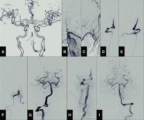 Angiography Images On The Second Day Of Hospitalization A 3D CTA