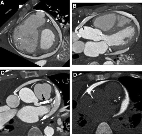 Rapid Progression Of Pericardial Calcification Containing A “calcium