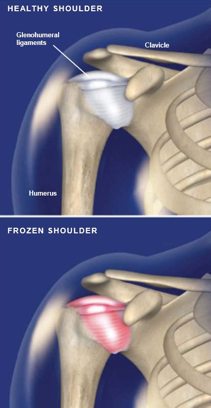 Hombro Congelado Capsulitis Adhesiva Grupo M Dico Ortop Dico De La