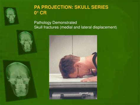 Ppt Positioning Of The Skull Powerpoint Presentation Free Download Id 4499009