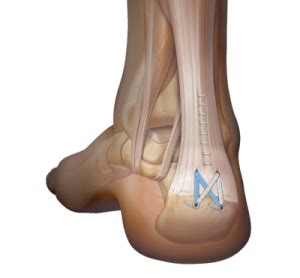 Surgery for Insertional Achilles Tendinopathy - London Sports Orthopaedics