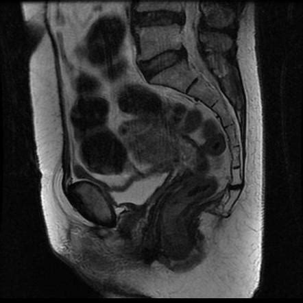 Endometrioid Adenocarcinoma Of The Endometrium Radiology Case