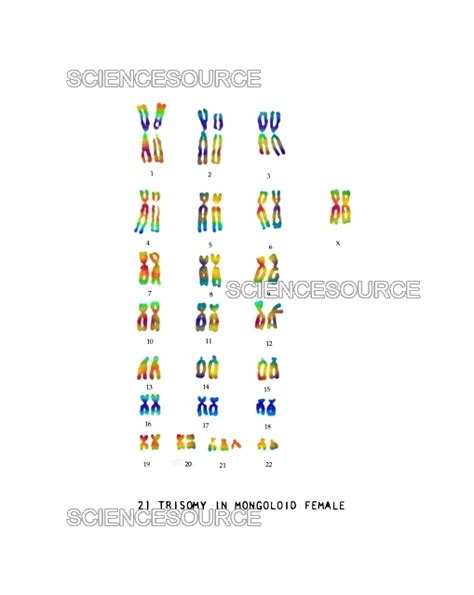 Photograph Female Karyotype Showing Downs Syndro Science Source Images