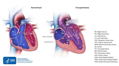 About Tricuspid Atresia Congenital Heart Defects CHDs CDC