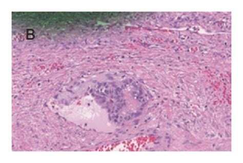 A Papillary Thyroid Carcinoma Arising In Struma Ovarii B Vascular