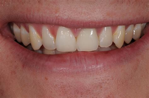 Services Nice Porcelain Crowns Brisbane Prosthodontics