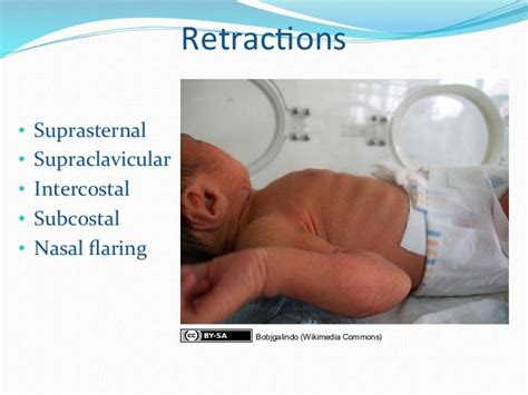 Gemc Pediatric Respiratory Distress Resident Training