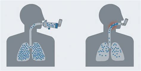 Minimising The Environmental Impact Of Inhalers