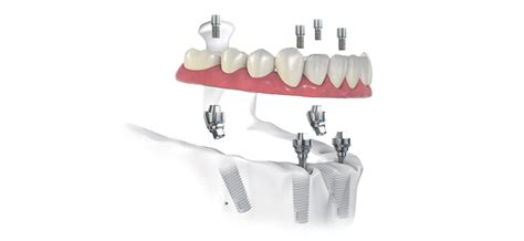 Tri Dental Implants Immediacy