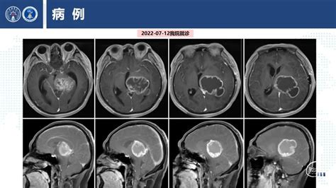 上海长海医院神经外科：丘脑巨大胶质瘤诊断及手术的精准理念