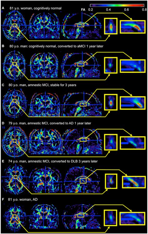 Frontiers Alzheimers Disease And The Fornix Frontiers In Aging