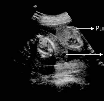 Grossly malformed acardiac twin and normal structure pump twin ...