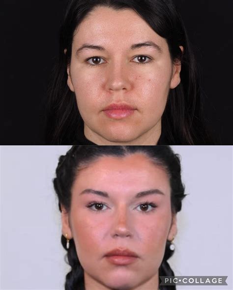 A Face Lift To Enhance Your Beauty Md Burak Sercan Erçin