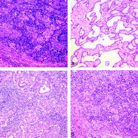 A EBV Associated Lymphoepithelioma Like Carcinoma Primarily Composed