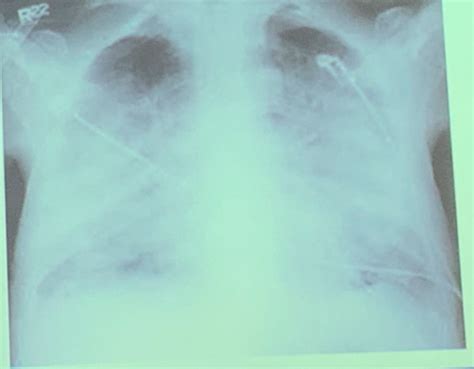 Chest Xray Flashcards Quizlet