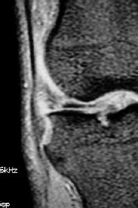 Radiologia Do Esporte Imagens Em Entorse De Joelho