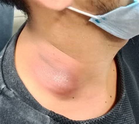 Cervical Tuberculous Lymphadenitis Bmj Case Reports