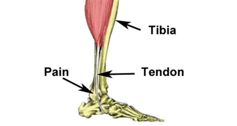 Peroneal Tendonitis Tendinopathy Symptoms Causes And Treatment