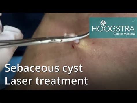 Sebaceous cyst - Laser treatment (20150) - Oasis Medical Aesthetics