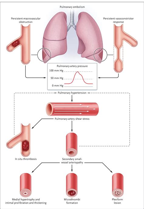 Chronic Thromboembolic Pulmonary Hypertension Nejm