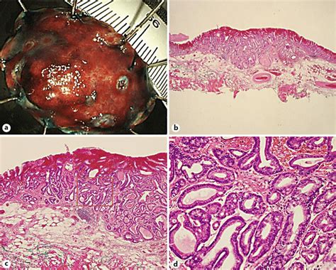 Figure 2 From A Case Of Early Gastric Cancer Arising From Gastritis