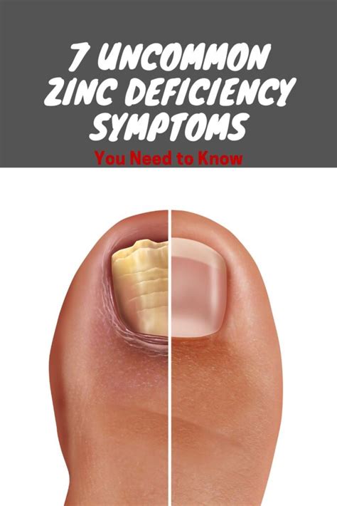 Uncommon Zinc Deficiency Symptoms You Need To Know Life Of A Hero