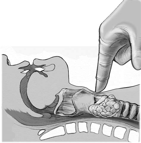 Emergency Cricothyrotomy Operative Techniques In Otolaryngology Head