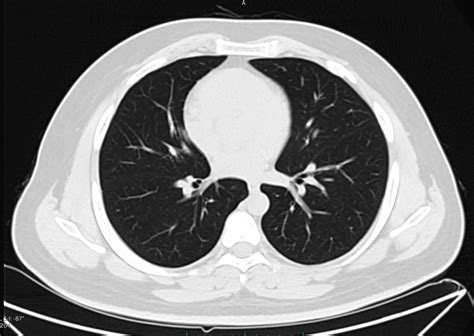 Supernumerary Intrathoracic Rib Image Radiopaedia Org