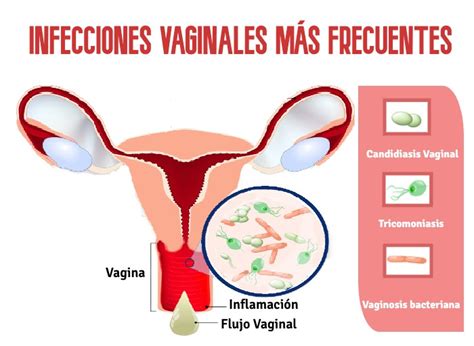 Infecciones Vaginales Y Enfermedad Pelvica Inflamatoria Hot Sex Picture