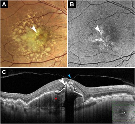 Vitelliform Maculopathy Diverse Etiologies Originating From One Common Pathway Survey Of