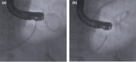 Thintipped Balloon Catheterassisted Removal Of A Fractured Pancreatic