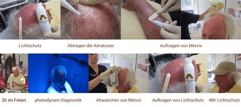 Aktische Keratose Archive Dermatologie am Dom München