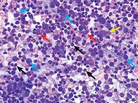 Top 5 Cytologic Findings In Aspirates Of Enlarged Lymph Nodes